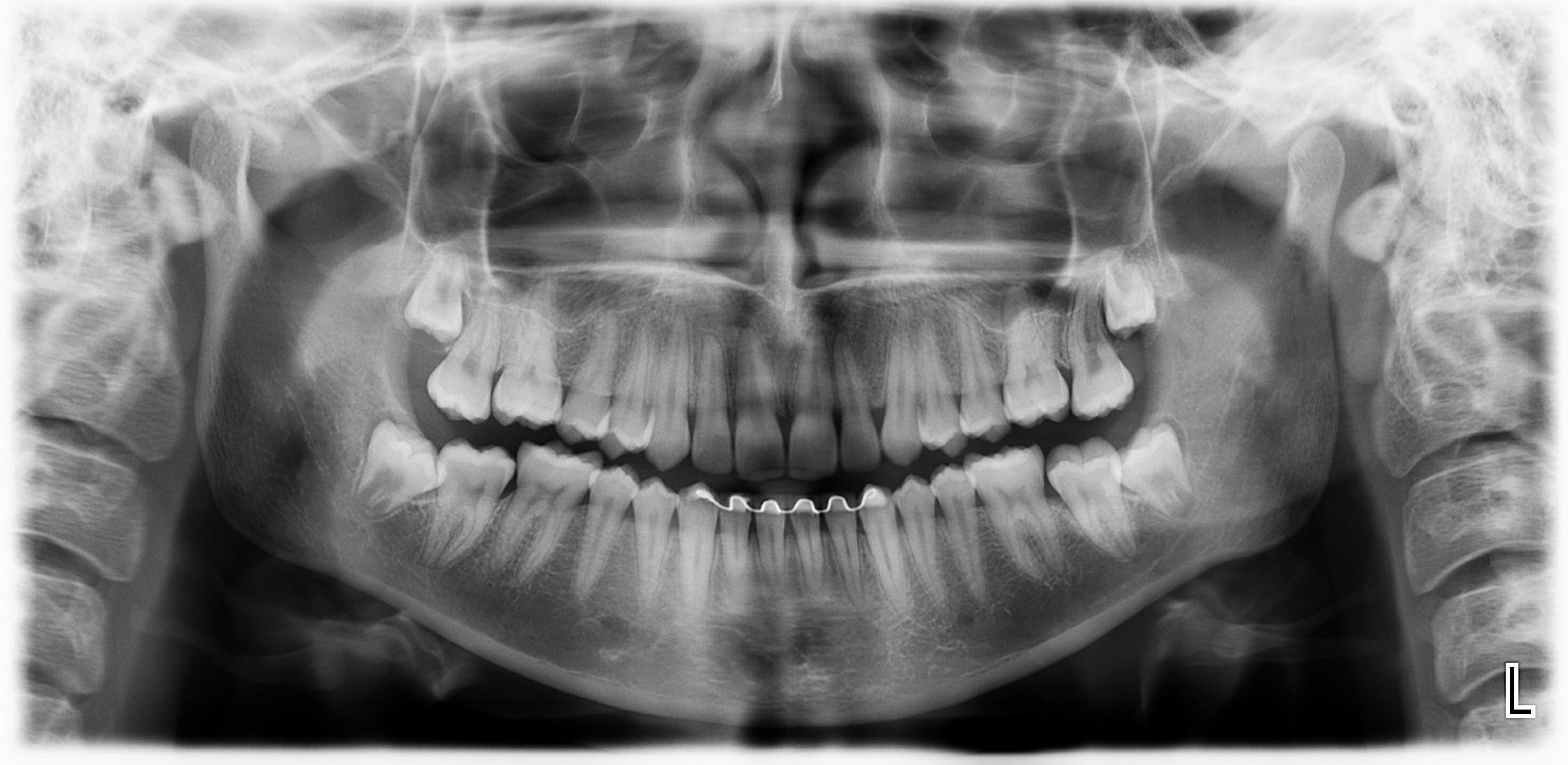 Radiografia Panorâmica